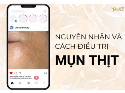 Điều Trị mụn